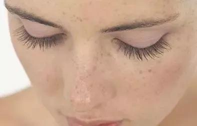 美国祛斑流行,欧美天然美白祛斑法