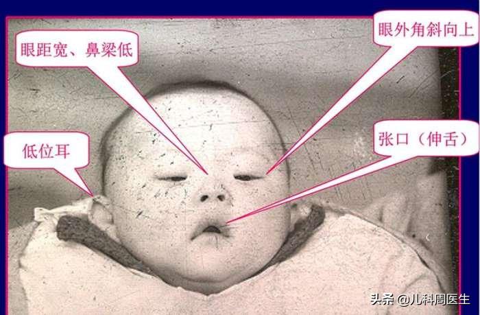 高龄唐筛21三体临界风险有没有事,唐筛21三体综合征会不会误诊