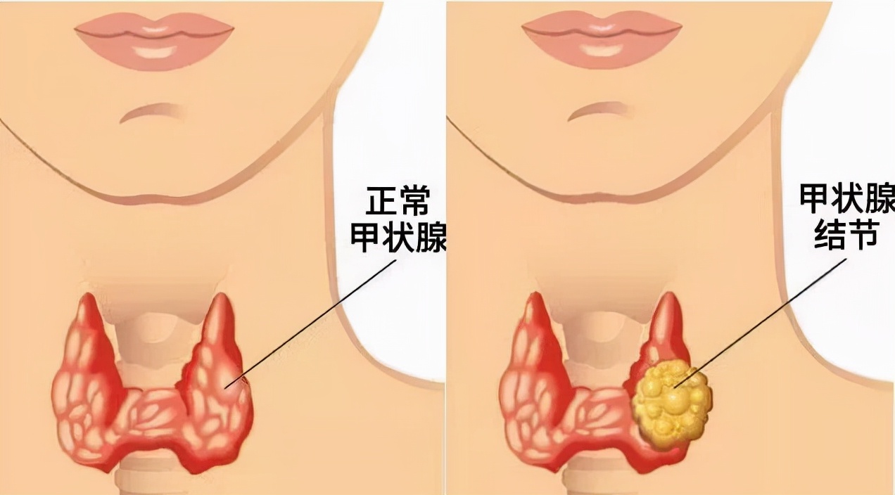 甲状腺射频消融与微波消融哪个好,甲状腺微波消融的适应症与禁忌症