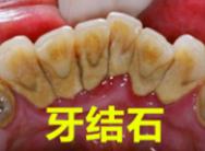 牙结石要怎么处理才干净,人牙结石处理过程