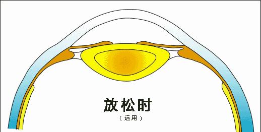 母亲高度近视孩子近视,爸爸近视妈妈近视孩子近视怎样