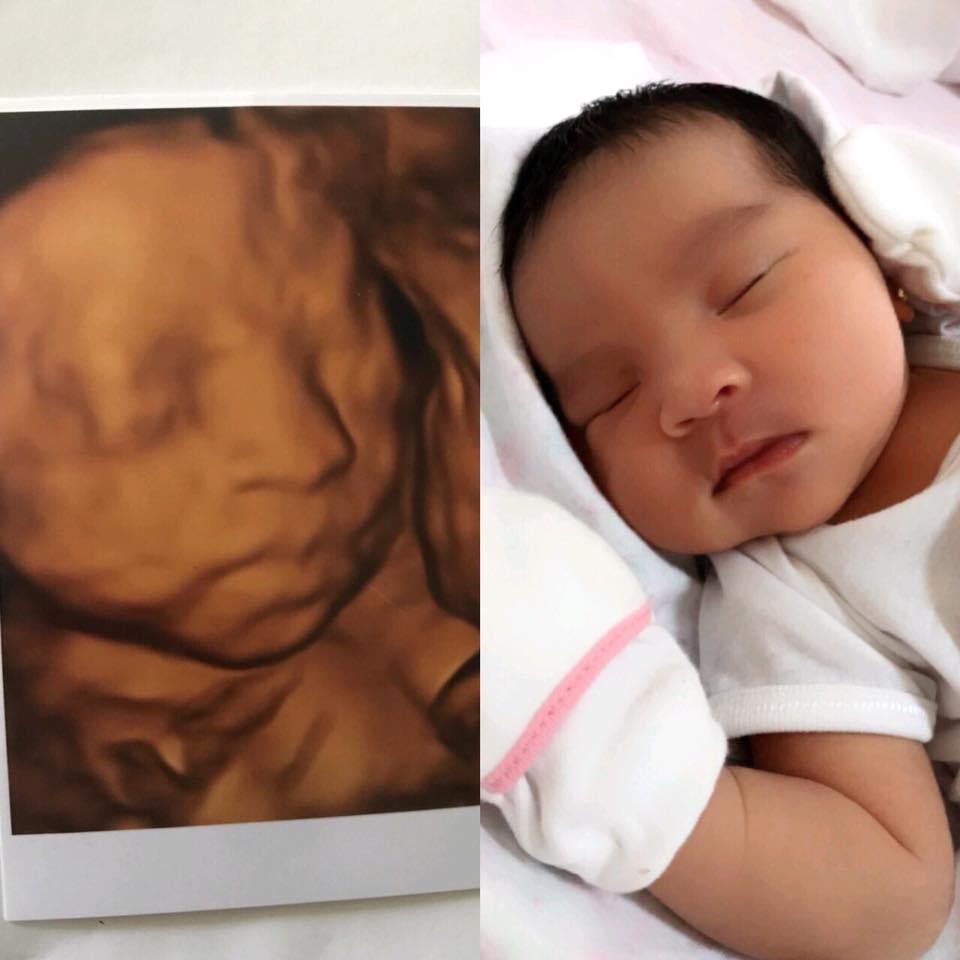 胎儿四维看哪几个指标,孕期做四维宝宝能看清楚吗