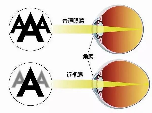 近视眼镜会不会影响颜值,眼睛近视了会影响颜值吗