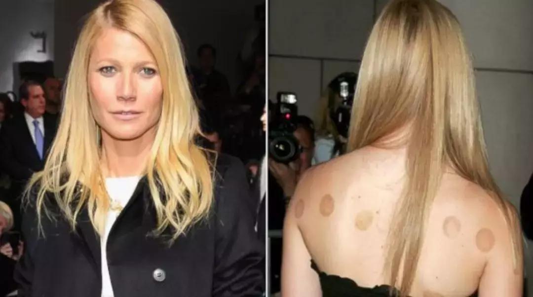 老外有多迷恋拔火罐,外国人吐槽中国拔罐