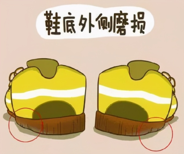 高弓足的保守锻炼治疗方法是什么,高弓足的表现和危害