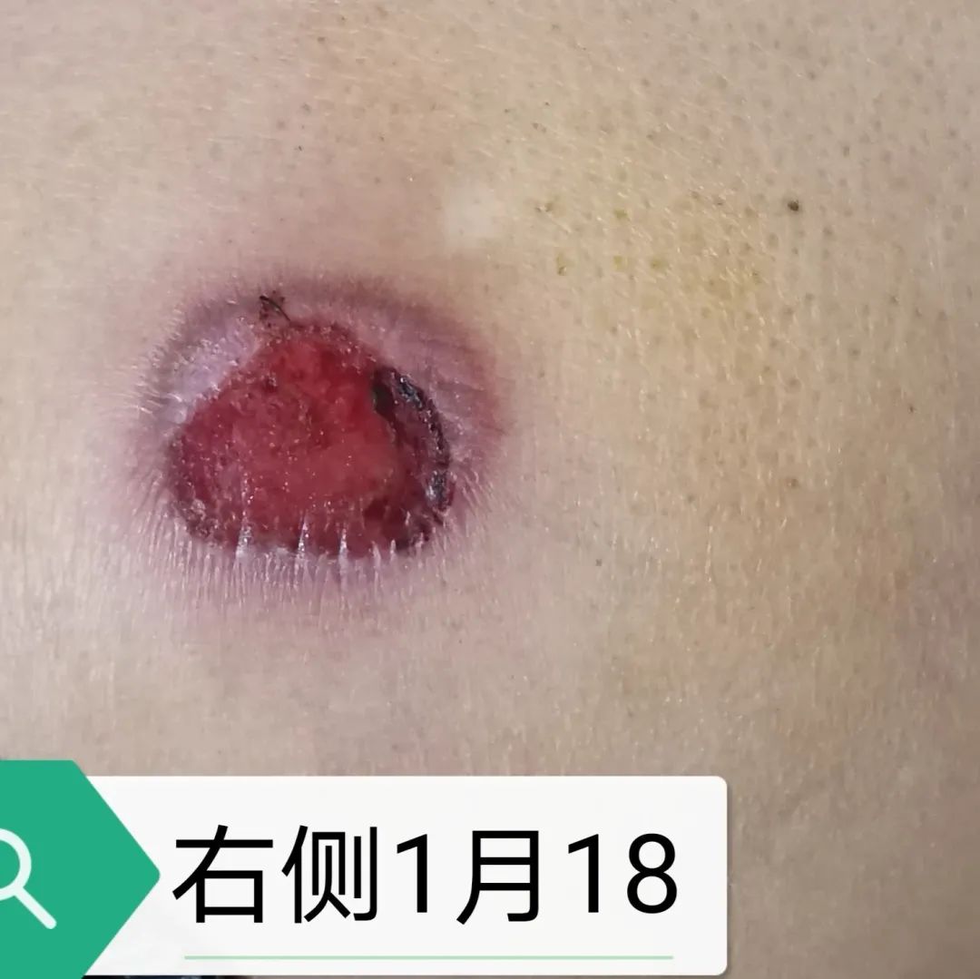 压疮的治疗成功和护理案例,压疮怎么护理好得快