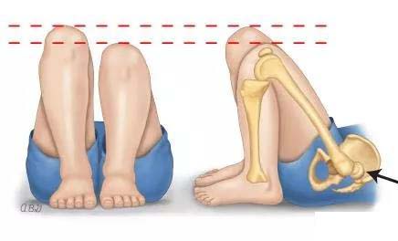 八个月宝宝臀纹腿纹不对称,宝宝臀纹不对称屁股一边大一边小