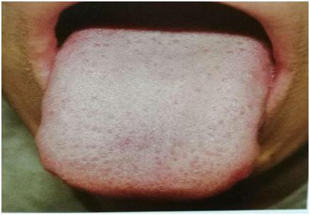 舌象大全及应对调理方法,中医教你从14种舌头的舌象看健康