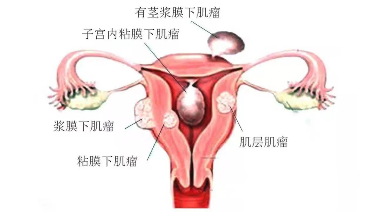 鸡蛋大小的子宫肌瘤能消除吗?