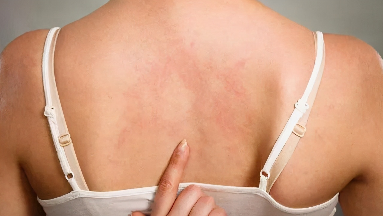 胸前背后过敏长痘痘怎么解决,胸前背后下巴长痘痘是什么原因