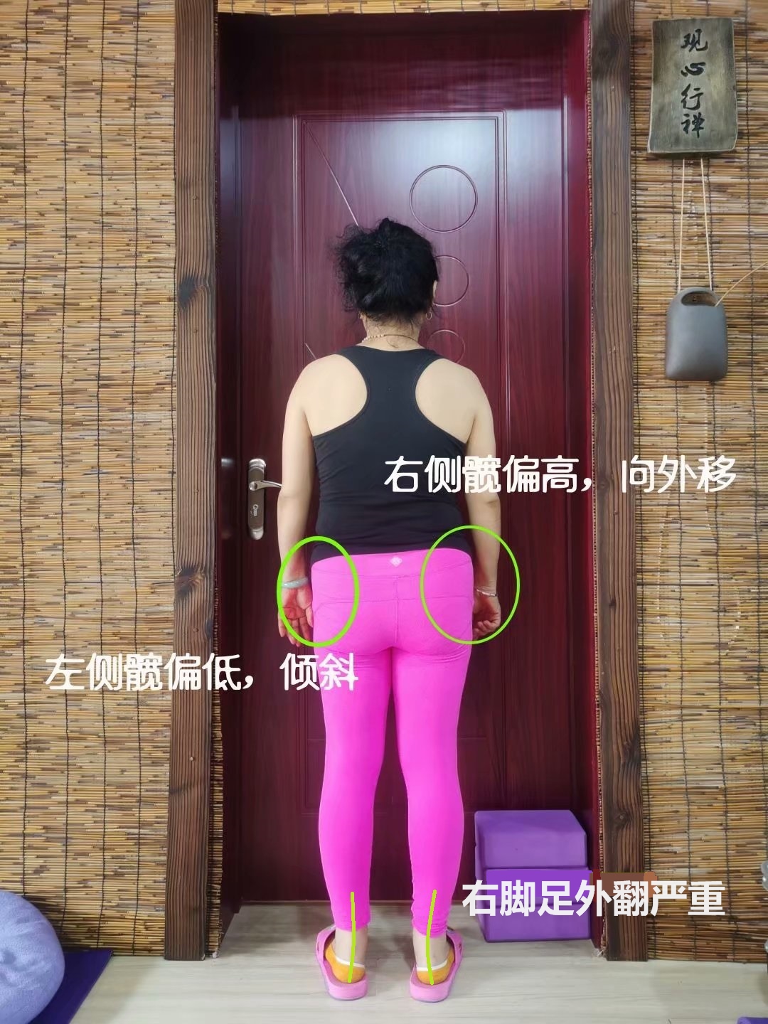 左右骨盆角度不一样,左侧骨盆比右侧骨盆突出怎么调整