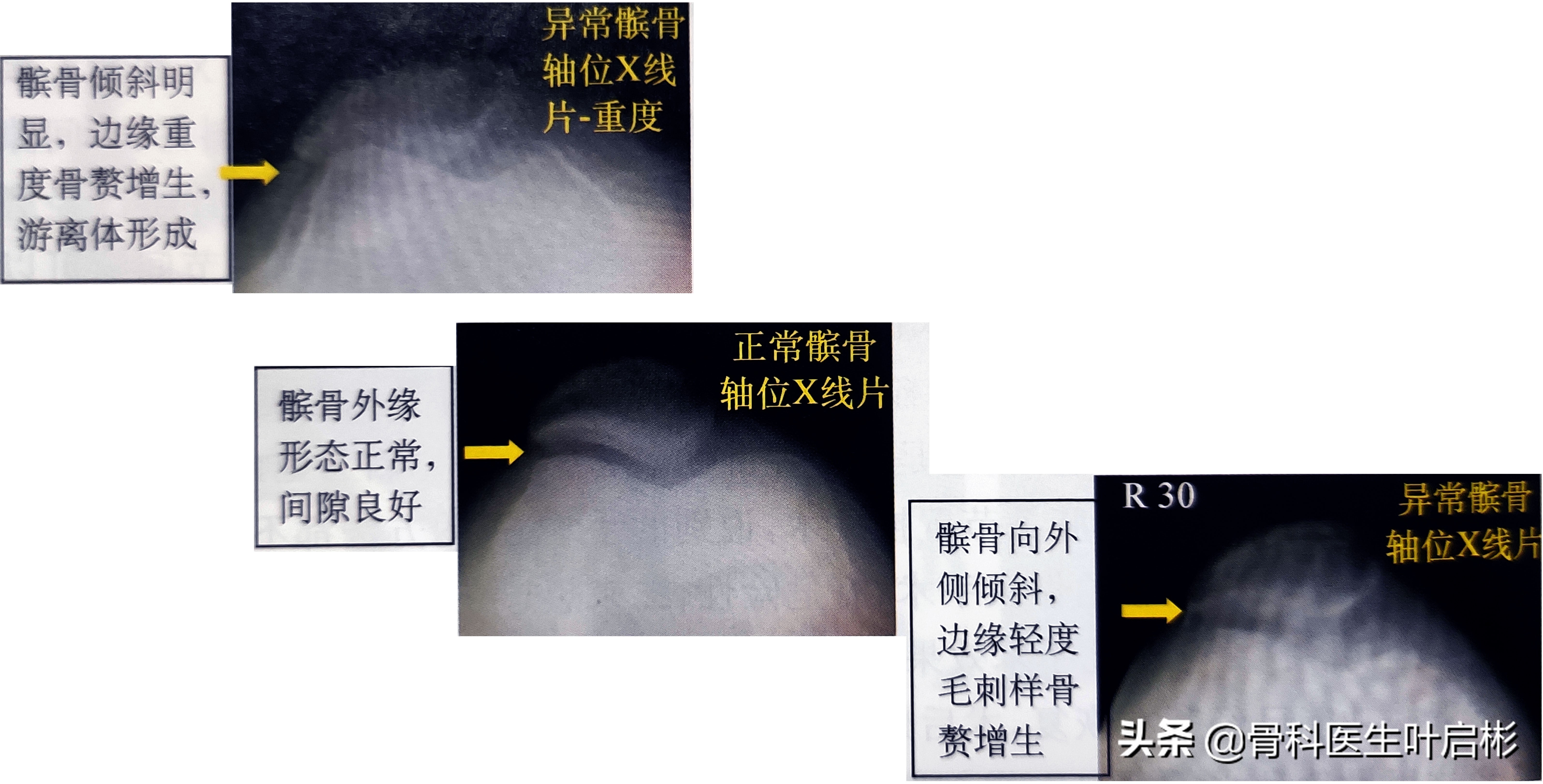 人工膝关节术中髌骨置换操作,微创手术修复关节软骨