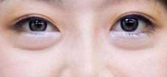 去眼袋做卧蚕全过程,去眼袋能让卧蚕更明显嘛