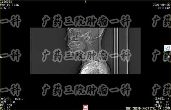 中山一院治疗甲状腺癌最好的医生,广州肿瘤医院治疗甲状腺癌怎么样