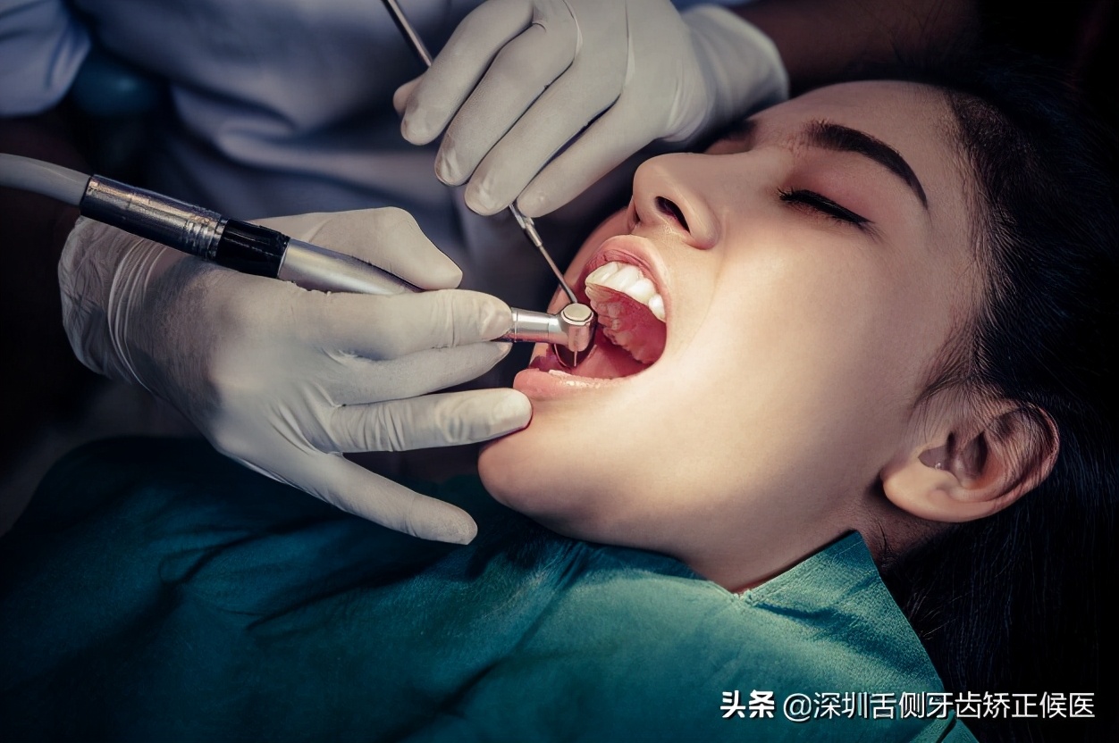 牙齿上有黑线怎么办,牙齿黑线的治疗视频