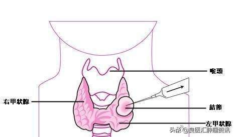 穿刺检查后疼痛、出血正常吗？哪些情况该再去医院跑一趟？