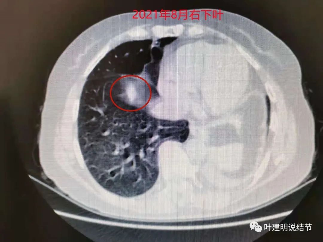 左肺癌手术半年右肺下角还有炎症,左下肺癌晚期
