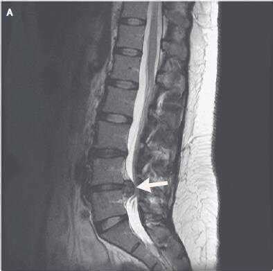 腰椎滑脱和腰椎间盘突出哪个严重,想知道腰椎间盘突出是怎样引起的