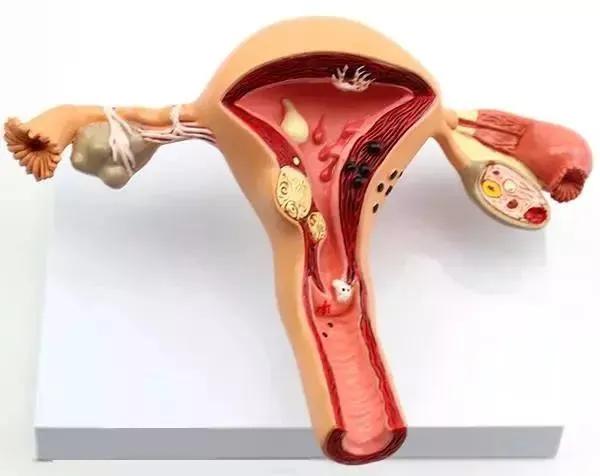 子宫里边长痘影响生育吗,子宫内膜囊肿会影响试管着床吗