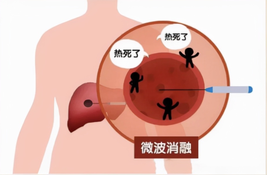 肿瘤介入微创疗法要多少钱,微创治疗肿瘤有哪些手段