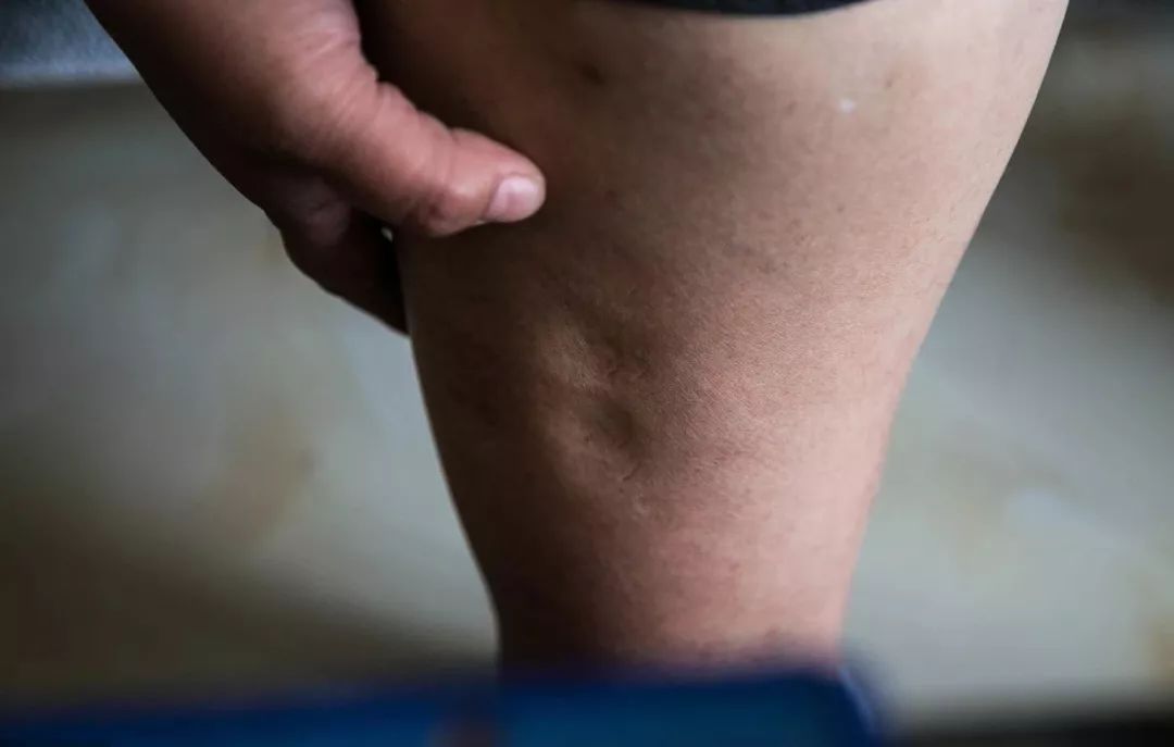 卵巢癌早期6个症状，越早发现越能救命！