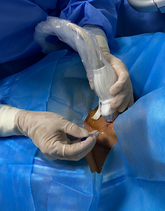 甲状腺结节微波消融术,厦门有微波消融术治疗甲状腺结节