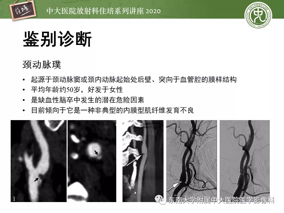 颈动脉夹层的超声表现及漏诊分析,动脉夹层与夹层动脉瘤是一样的吗