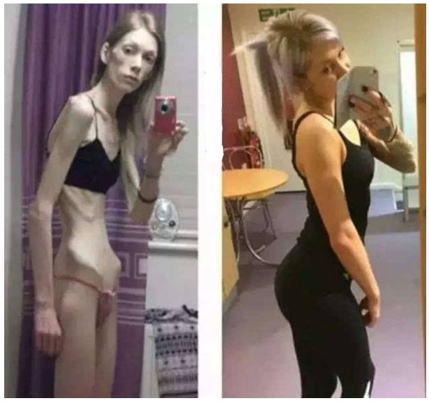 减肥后脸上皮肤松弛大概多久恢复,肚子减肥后皮肤松弛下垂怎么办