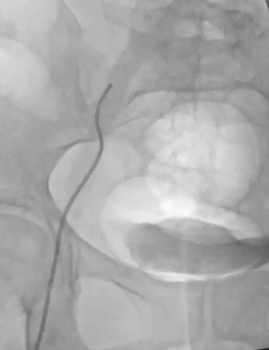 原发性右髂股静脉血栓形成治疗,左侧股髂静脉血栓预后