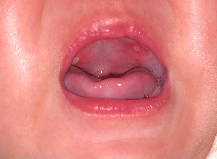 宝宝口腔溃疡有什么办法好得快,要想宝宝牙好做好这6点