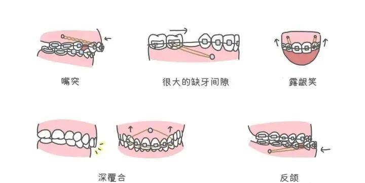 支抗钉和骨钉的区别,13岁矫正牙齿打骨钉亲身经历