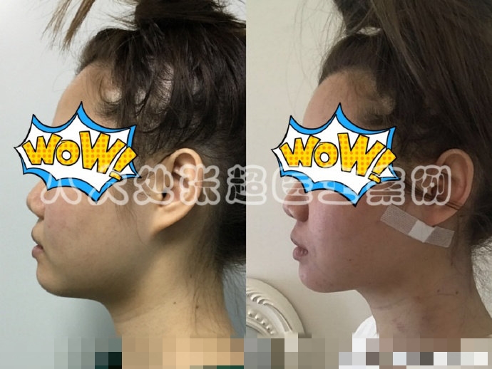 八大处整形张超,八大处张超最新视频