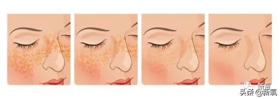 宋祖儿雀斑造型美到窒息,宋祖儿脸上的雀斑一清二楚