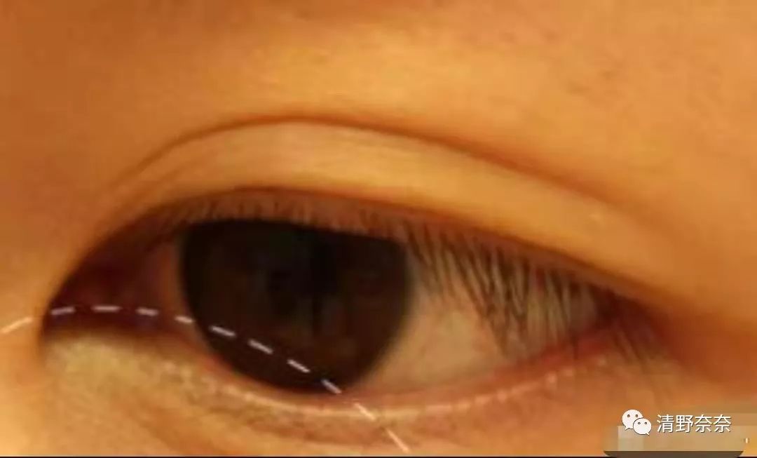 四十岁有法令纹川字纹医美项目,法令纹和鱼尾纹用医美怎么处理