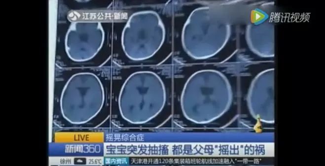 1岁宝宝偏瘫上肢康复训练,1岁孩子偏瘫康复视频