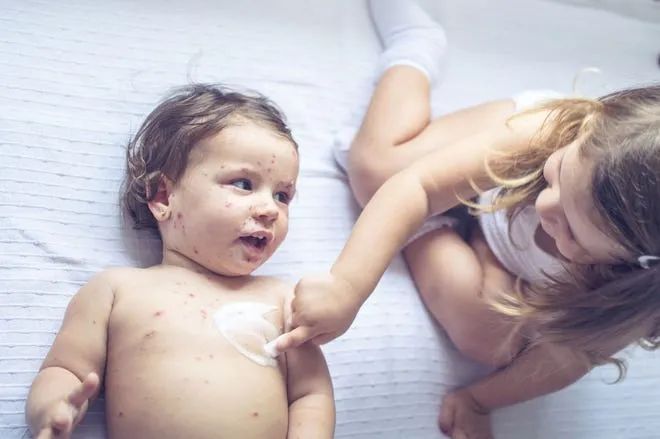 英美流行的奇葩“水痘派对”，是对现代传染病防治的巨大羞辱