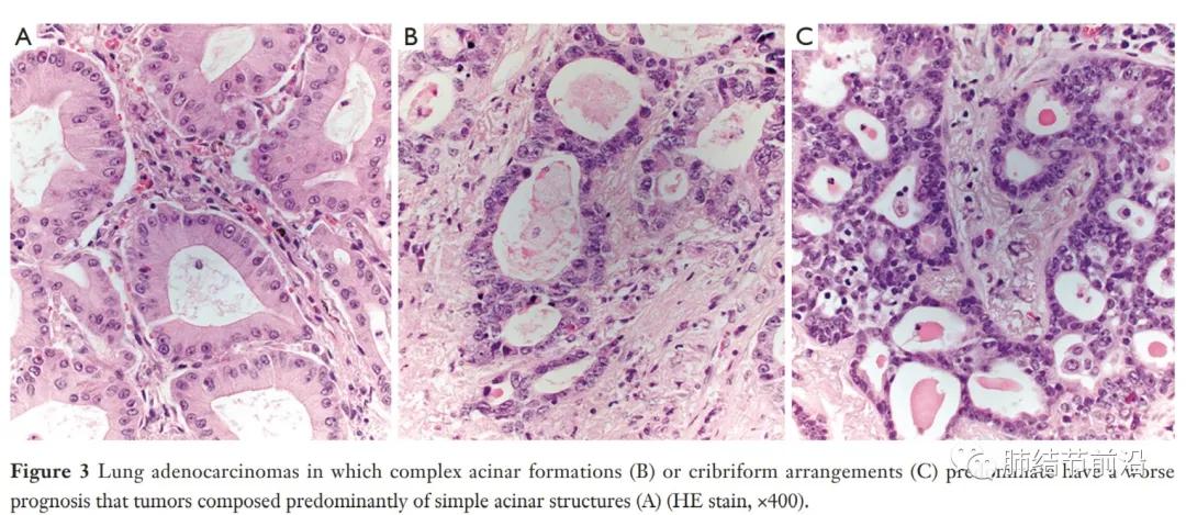 早期肺腺癌分哪几种,微浸润肺腺癌病理为什么没有分型