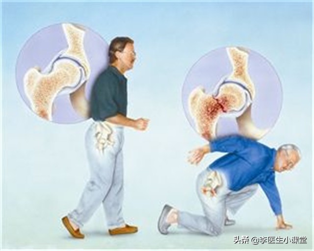 更年期骨质疏松吃什么药止疼好,骨质疏松胳膊疼痛吃什么药止疼