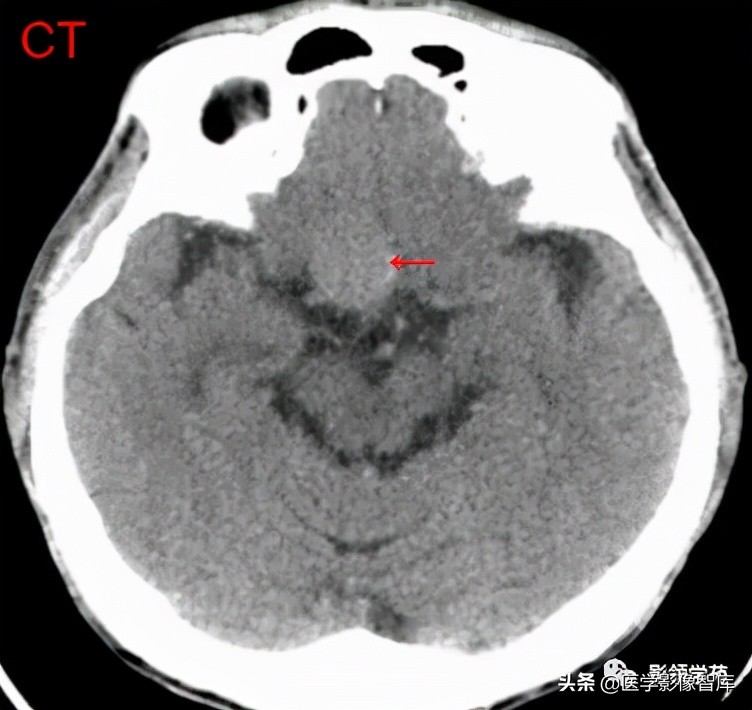 鞍区肿瘤做什么检查得出来,鞍区肿瘤的影像学鉴别