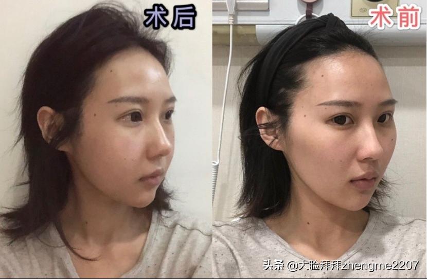 颧骨颧弓内推手术全过程真人,颧骨内推颧弓手术恢复全过程分享