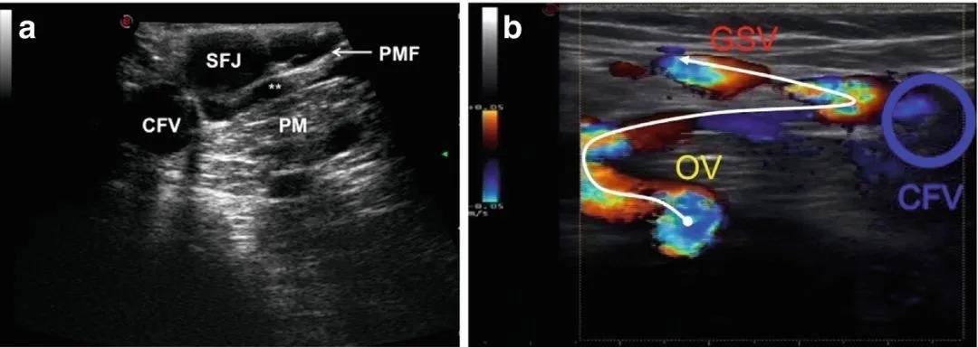 chiva治疗下肢静脉曲张价格,chiva治疗静脉曲张