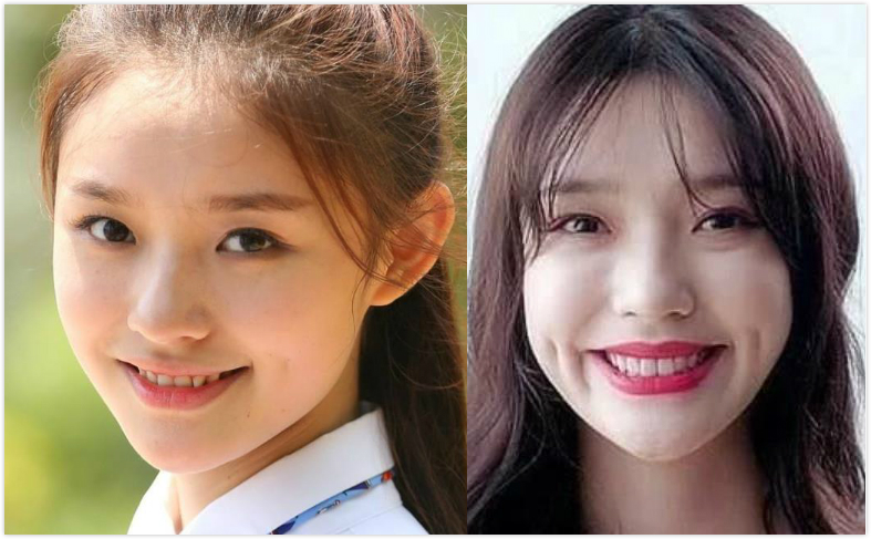 赵薇牙齿做了烤瓷牙吗,吴宣仪牙齿烤瓷牙