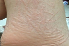 人工性荨麻疹是怎么引起的,人工性荨麻疹都有什么症状