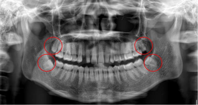 智齿发炎嘴巴张不开脸肿睡不着,智齿发炎脸硬怎么办