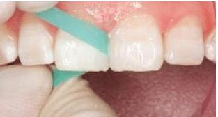 门牙缝可以补吗,门牙有缝怎么办如何补救