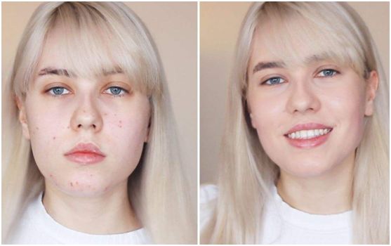 片仔癀痘痘贴解救痘痘,片仔癀祛痘印最有效的方法