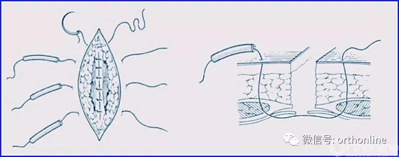 常用的手术缝合方法图,临床常见常用伤口缝合方法