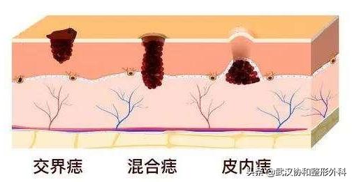 两毫米的痣医生要切,切痣医生怎么判断有没有切干净