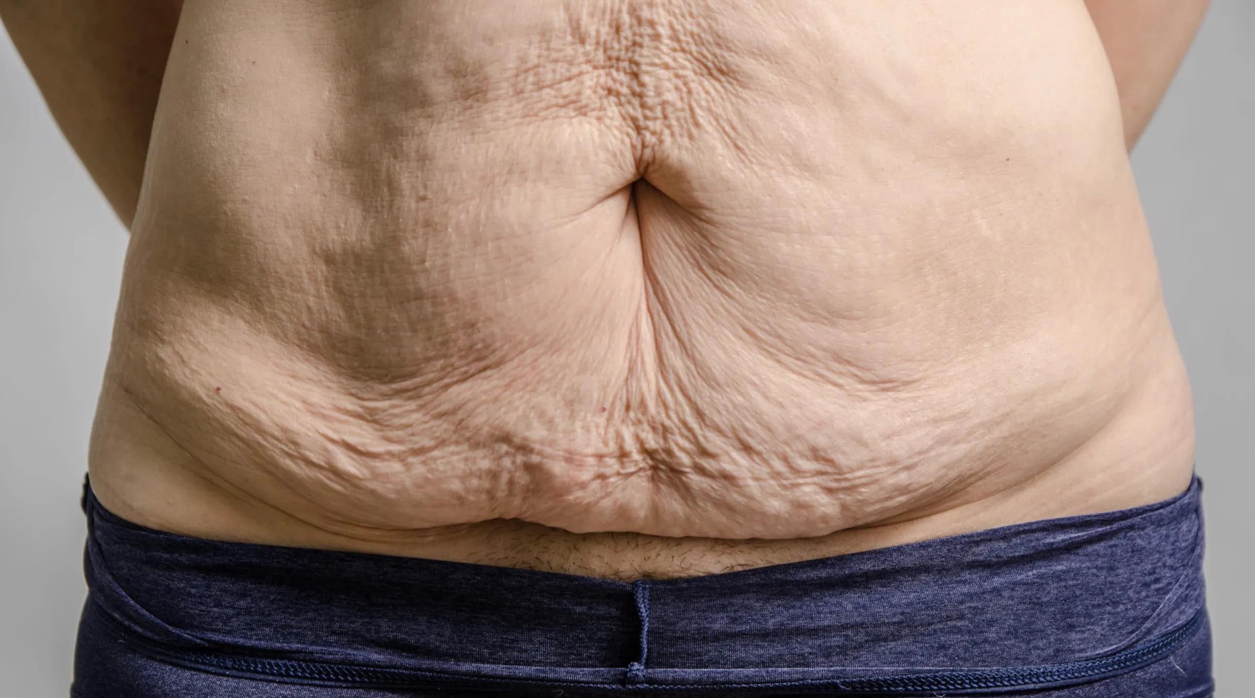 26岁双胎妈妈,双胎剖腹产肚子松弛