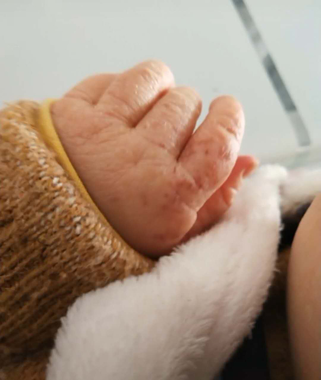 宝宝皮肤粗糙像砂纸怎么办,宝宝四肢粗糙颗粒状怎么回事